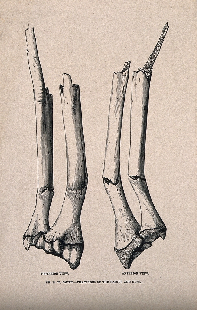 Fractures radius ulna bones, anterior